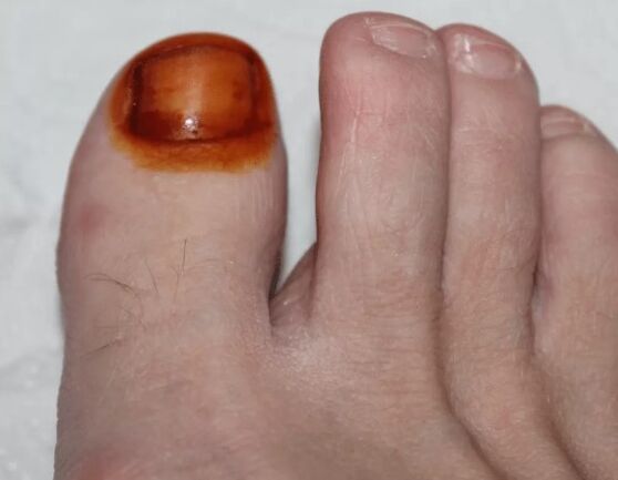 Zdravljenje glive joda