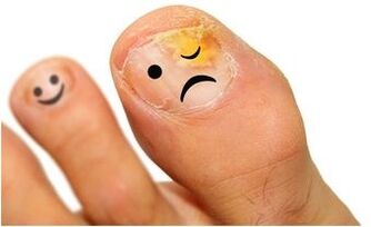 rumene glivice na nohtih