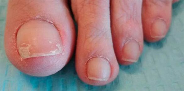 stopnje glivičnih nog