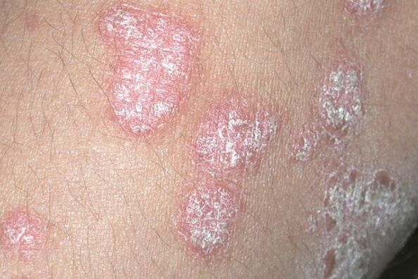 Psoriaza, ki jo povzroča glivična okužba